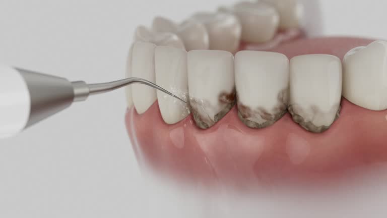 Trusted Wisdom Tooth Removal service in Huntertown, IN - Dentist Open Now